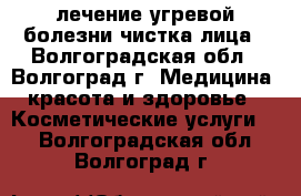 лечение угревой болезни,чистка лица - Волгоградская обл., Волгоград г. Медицина, красота и здоровье » Косметические услуги   . Волгоградская обл.,Волгоград г.